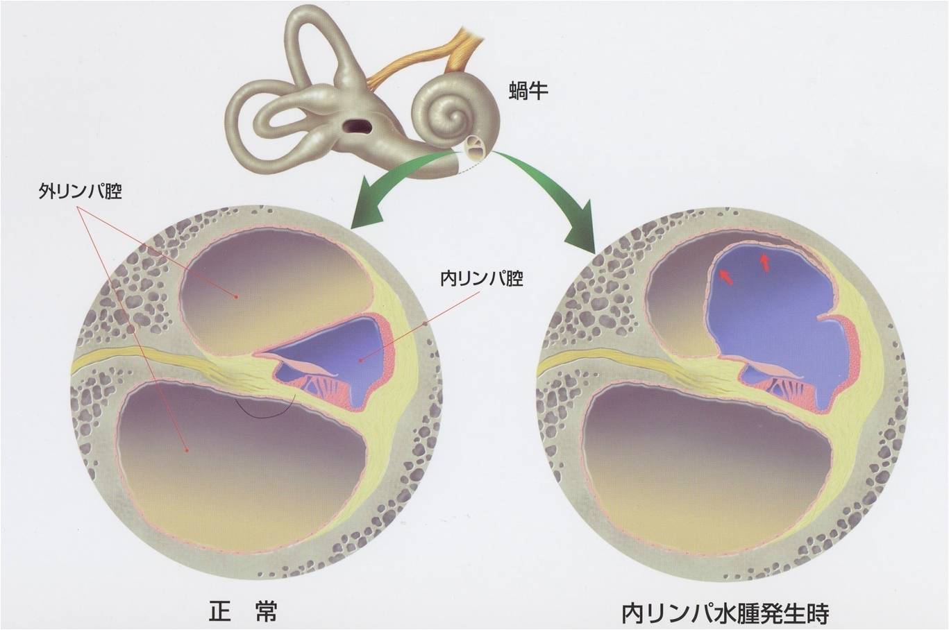 メニエール病