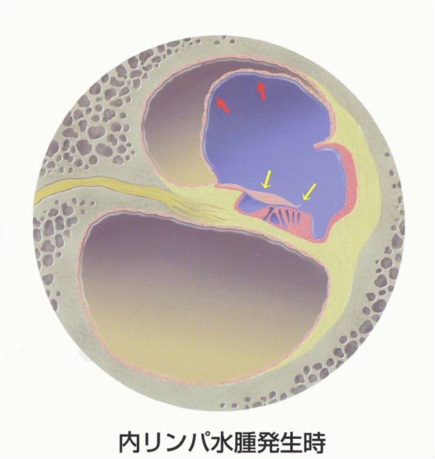 メニエール病