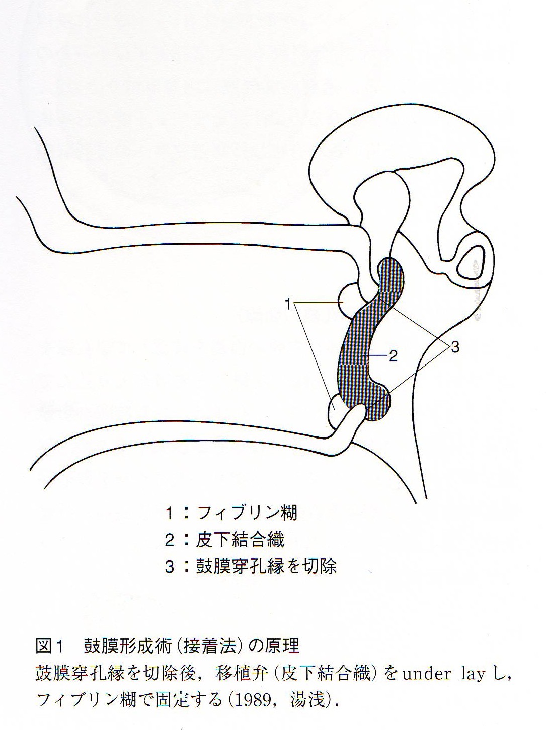 鼓膜穿孔に対する鼓膜形成術（接着法）