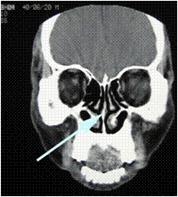 鼻閉の改善を目指す鼻中隔彎曲矯正術・下甲介切除術