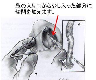 鼻中隔矯正術