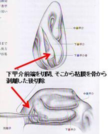 下甲介手術