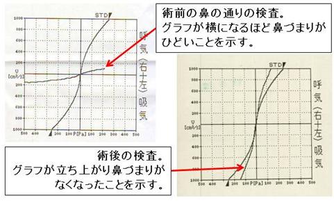 手術前後の比較