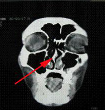 睡眠時無呼吸症候群　発症メカニズム