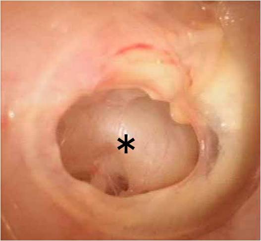 慢性中耳炎の鼓膜穿孔（＊）