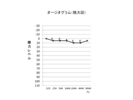 オージオグラム（聴力図）