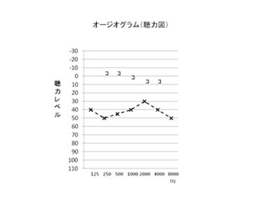 オージオグラム（聴力図）