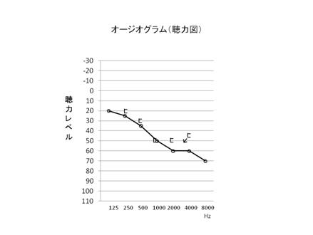 オージオグラム（聴力図）