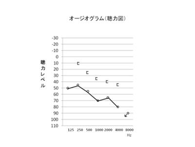 オージオグラム（聴力図）