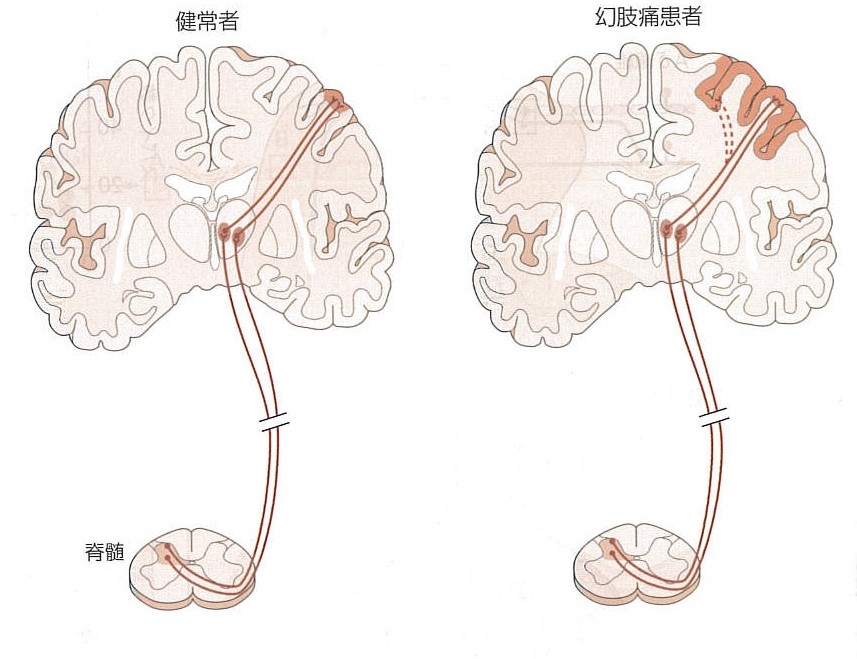 正常人と幻肢のある人の脳の研究